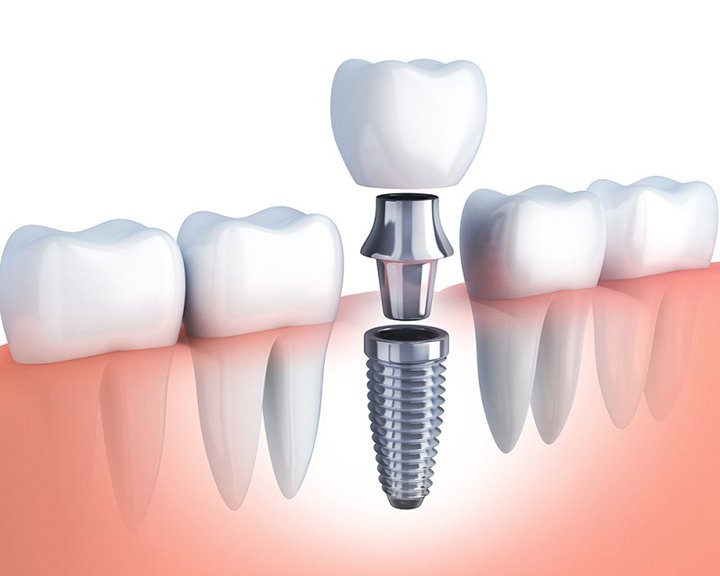 Phục hình Implant